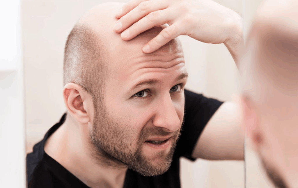 Man who has Frontal Fibrosing Alopecia, looking concerned, holding his head in front of the mirror